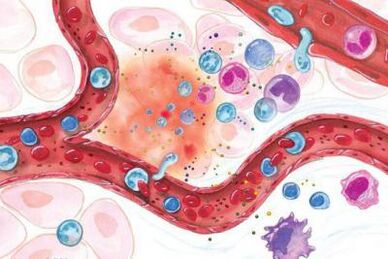 Účinek Boswellia na zanícené oblasti těla