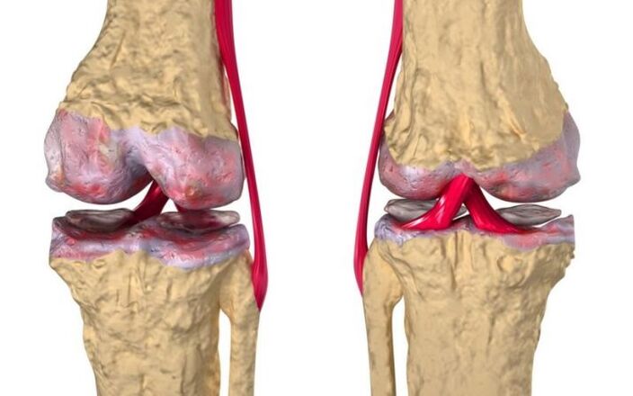 Osteoartróza kolenního kloubu